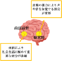 イラスト：体罰等による脳への影響　聴覚野：言葉の暴力により声や音を知覚する部分が変形　前頭前野：体罰により社会生活に極めて重要な部分が委縮